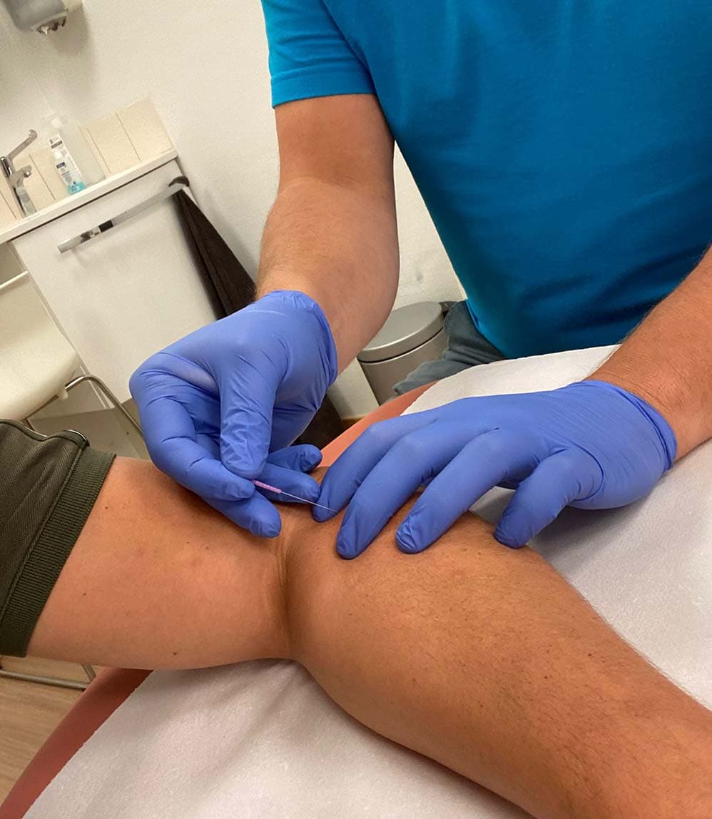 Dry Needling